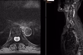 Phát hiện xẹp nhiều đốt sống do loãng xương nặng