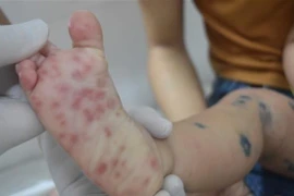 Hà Nội ghi nhận tăng ca bệnh tay chân miệng