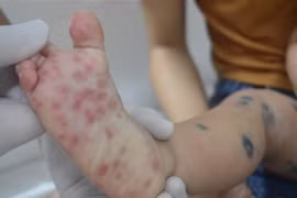 Hà Nội ghi nhận tăng ca bệnh tay chân miệng