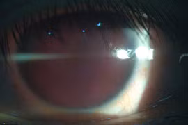 Nam thanh niên chấn thương mắt do nổ bóng đèn huỳnh quang