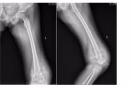 Phẫu thuật thay khớp gối cho bệnh nhi 10 tuổi mắc ung thư xương