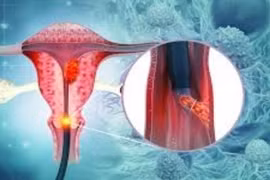 Mỗi năm ghi nhận khoảng 6.200 ca ung thư liên quan đến HPV