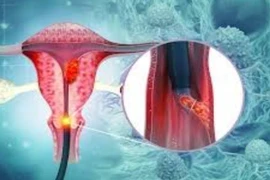 Mỗi năm ghi nhận khoảng 6.200 ca ung thư liên quan đến HPV