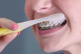 Cách chăm sóc răng miệng khi niềng răng