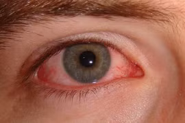 WHO công nhận Việt Nam đã thanh toán bệnh mắt hột