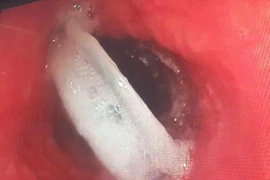 Cụ ông nuốt cả nắp chai khi uống nước