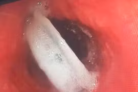 Cụ ông nuốt cả nắp chai khi uống nước