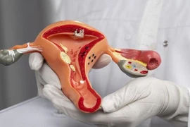 Hơn 2.500 phụ nữ Việt tử vong vì ung thư cổ tử cung mỗi năm