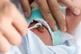 Bé trai 10 ngày tuổi nguy kịch do gia đình dùng kéo không vô trùng cắt rốn