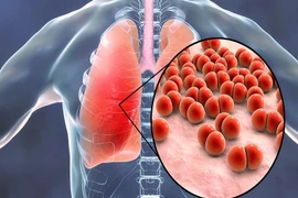 Cảnh báo mức độ nguy hiểm của nhiễm nấm phổi