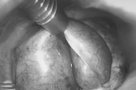 Cấp cứu thành công hai ca xoắn cơ quan sinh dục nguy hiểm