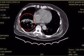 Người đàn ông ho ra máu nặng do giãn phế quản được cứu sống ngoạn mục