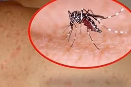 Hà Nội ghi nhận 190 trường hợp mắc sốt xuất huyết trong tuần qua