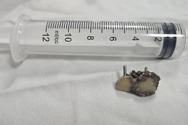 Gắp thành công 2 chiếc răng giả bỏ quên trong phổi bệnh nhân hơn 20 năm 