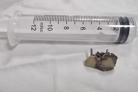 Gắp thành công 2 chiếc răng giả bỏ quên trong phổi bệnh nhân hơn 20 năm 