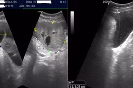 Người phụ nữ trẻ phát hiện ung thư buồng trứng từ triệu chứng chướng bụng 