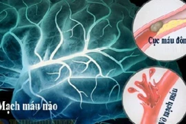 Thói quen phổ biến vào mùa lạnh làm tăng nguy cơ đột quỵ