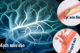 Thói quen phổ biến vào mùa lạnh làm tăng nguy cơ đột quỵ