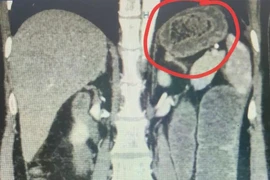 Nhập viện cấp cứu vì tắc ruột do bã thức ăn