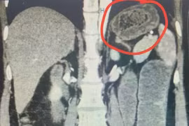 Nhập viện cấp cứu vì tắc ruột do bã thức ăn