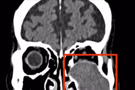 Người bệnh 76 tuổi bị khối u nhầy xoang hàm ăn mòn xương, ổ mắt