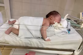 Cứu sống bệnh nhi mắc chứng mềm khí quản bẩm sinh 