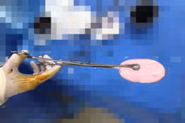 Bé gái 12 tuổi nhập viện vì nhét xà phòng vào vùng kín, cảnh báo nguy hiểm