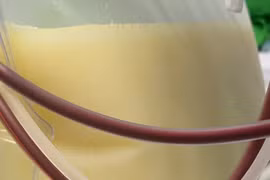 Cứu sống người phụ nữ có mỡ máu cao gấp 37 lần