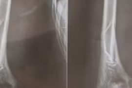 Chơi trò “vật tay”, nam thanh niên 18 tuổi bị gãy xương cánh tay phải