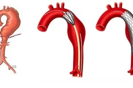 Cứu sống người đàn ông trung niên bị vỡ phình động mạch chủ ngực 