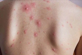 Thủy đậu ở người lớn bị biến chứng nặng do nhiễm trùng da