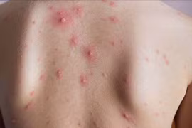 Thủy đậu ở người lớn bị biến chứng nặng do nhiễm trùng da