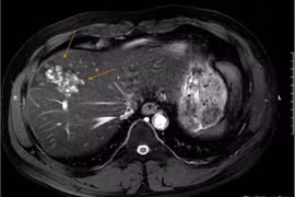 Người đàn ông 41 tuổi bị sán lá gan gây tổn thương nặng do hay ăn đồ sống