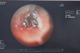 Gắp hạt hồng xiêm nằm trong phế quản người bệnh hơn 10 năm