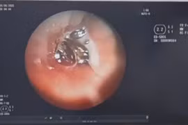 Gắp hạt hồng xiêm nằm trong phế quản người bệnh hơn 10 năm