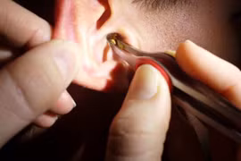 Người phụ nữ tổn thương thính lực do ngoáy tai