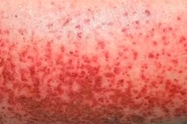 Tuần qua, Hà Nội ghi nhận 120 ca sốt xuất huyết tại 67 phường, xã 