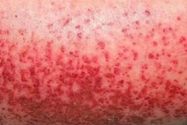 Tuần qua, Hà Nội ghi nhận 120 ca sốt xuất huyết tại 67 phường, xã 