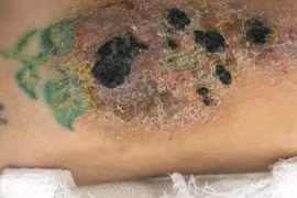 Bác sĩ da liễu cảnh báo trào lưu “họa da” trong giới trẻ