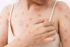 Thủy đậu gia tăng trong mùa đông xuân, phòng ngừa để tránh biến chứng nặng