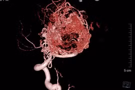 Cứu sống bệnh nhân 16 tuổi dị dạng mạch máu não 