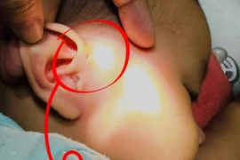 Bé gái 6 tháng tuổi bị áp xe thái dương do viêm lỗ rò luân nhĩ 