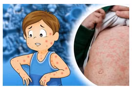 Điện Biên ghi nhận hơn 30 ca sởi