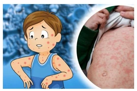 Điện Biên ghi nhận hơn 30 ca sởi