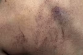 Cô giáo đã thừa nhận hành vi đánh bé gái 4 tuổi ở Hà Nội