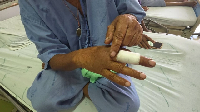Bà Chalaem bị cắn vào ngón giữa bên phải.