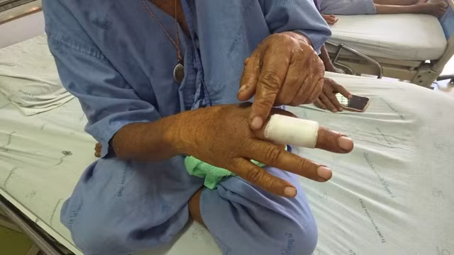 Bà Chalaem bị cắn vào ngón giữa bên phải.