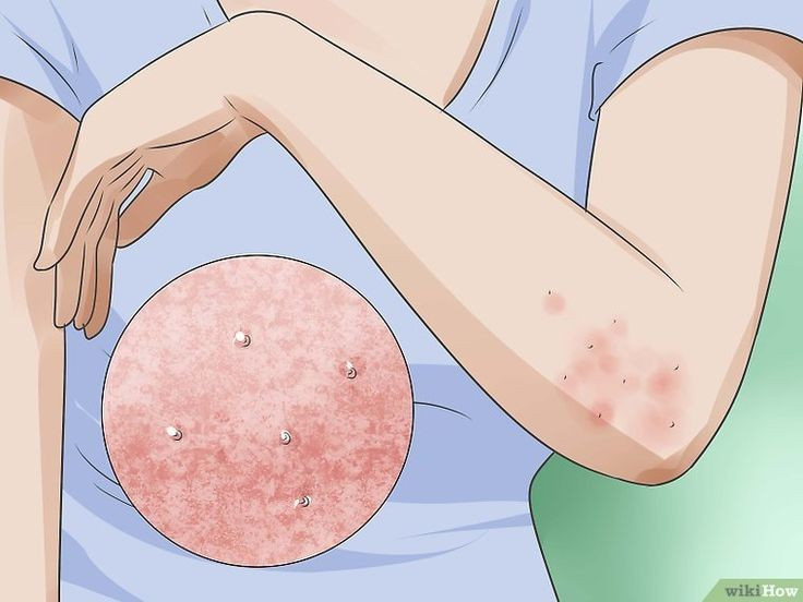  Không chỉ có ở người. Nhiều biến thể của Sarcoptes scabiei còn ký sinh trên động vật như chó, mèo, cáo… Tuy nhiên, mỗi biến thể thường “ưu tiên” vật chủ riêng, dù đôi khi vẫn có thể lây chéo tạm thời. Ảnh: Pinterest.