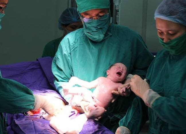Em bé chào đời sau ca phẫu thuật sinh đôi kéo dài nhiều giờ đồng hồ. (Ảnh: Bệnh viện Sản Nhi Quảng Ninh)