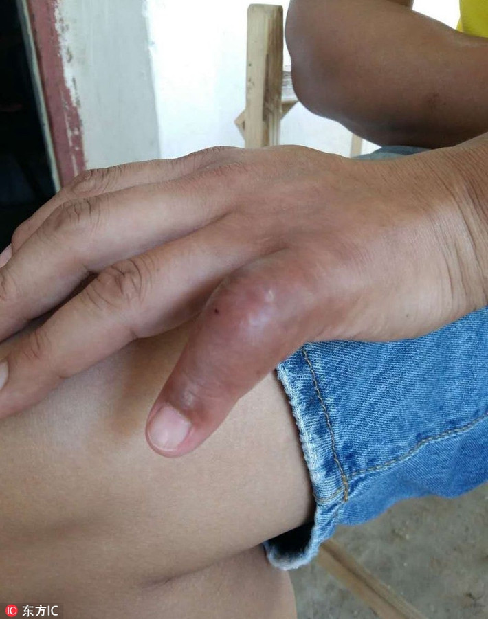 Cũng bởi vì nuôi rắn độc, chồng của "nữ hoàng rắn" Chân Chân trong một lần bất cẩn đã bị rắn độc cắn, tổn thương nghiêm trọng, 8 tháng nằm liệt trên giường, không thể đi lại. (Nguồn Sina)